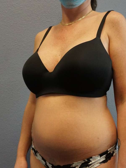 Liposuction Female Before & After Patient #8101