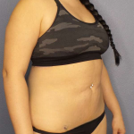 Liposuction Female Before & After Patient #8035