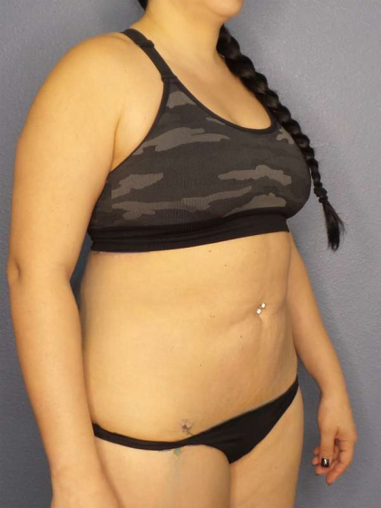 Liposuction Female Before & After Patient #8035
