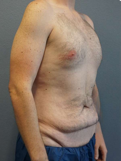 Male Liposuction Before & After Patient #3808