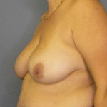 Breast Lift with Implant (Augmentation Mastopexy) Before & After Patient #3918