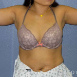 Liposuction Female Before & After Patient #7951