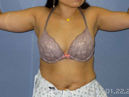 Liposuction Female Before & After Patient #7951