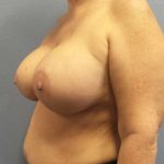 Breast Lift with Implant (Augmentation Mastopexy) Before & After Patient #4013