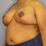 Mastopexy (Breast Lift) Before & After Patient #8402