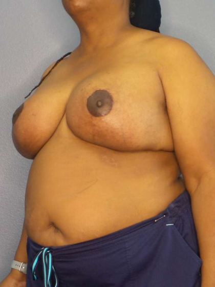 Mastopexy (Breast Lift) Before & After Patient #8402