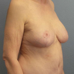 Mastopexy (Breast Lift) Before & After Patient #8377