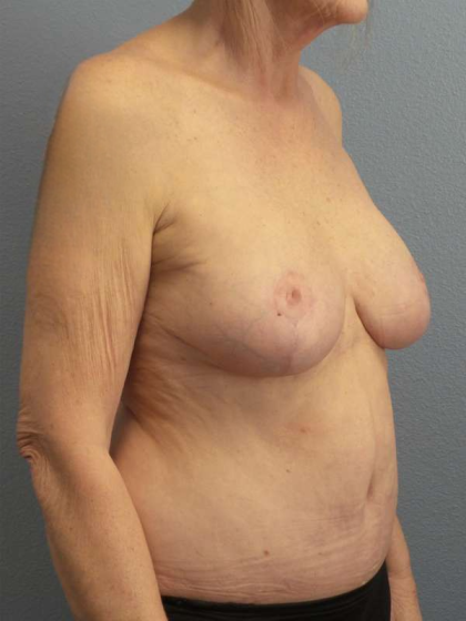 Mastopexy (Breast Lift) Before & After Patient #8377