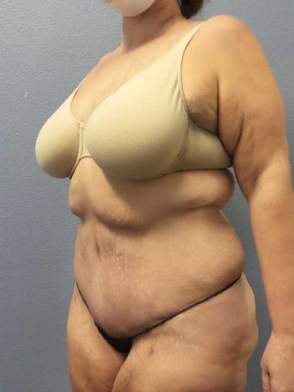 High BMI (Larger Patients) Surgery Before & After Patient #10393