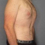 Male Liposuction Before & After Patient #3808