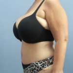 High BMI (Larger Patients) Surgery Before & After Patient #10438