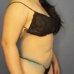 Liposuction Female Before & After Patient #8035