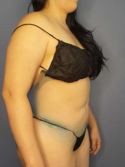 Liposuction Female Before & After Patient #8035