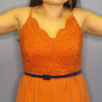 Liposuction Female Before & After Patient #7951