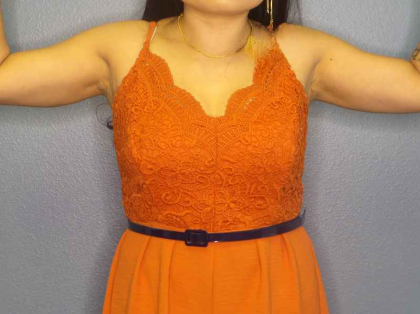 Liposuction Female Before & After Patient #7951