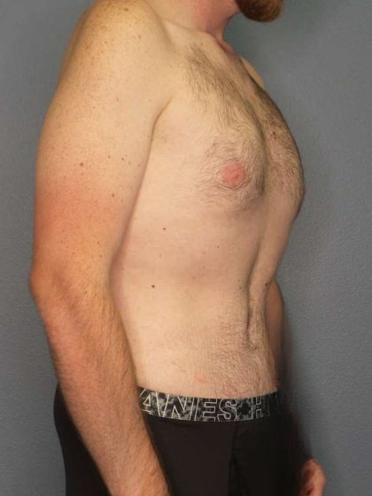 Male Liposuction Before & After Patient #3808