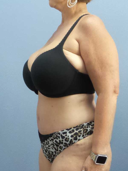 High BMI (Larger Patients) Surgery Before & After Patient #10438