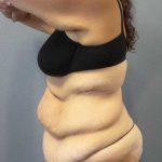 High BMI (Larger Patients) Surgery Before & After Patient #10393