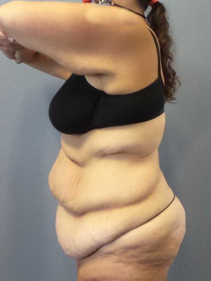 High BMI (Larger Patients) Surgery Before & After Patient #10393