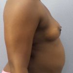 Breast Augmentation Before & After Patient #11436