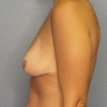 Breast Augmentation Before & After Patient #5952