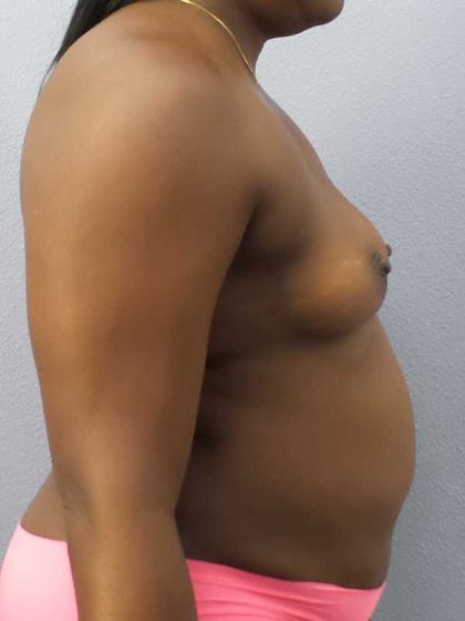 Breast Augmentation Before & After Patient #11436