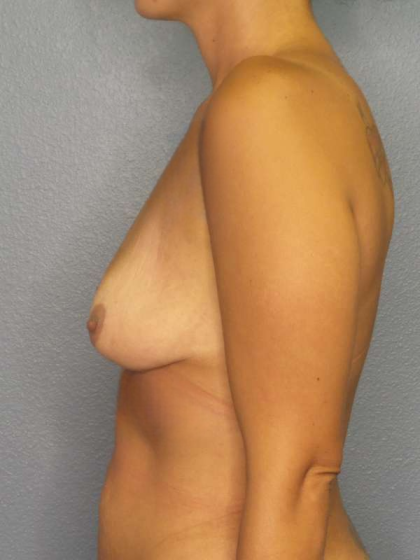 Breast Augmentation Before & After Patient #5952