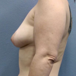 Breast Augmentation Before & After Patient #5729