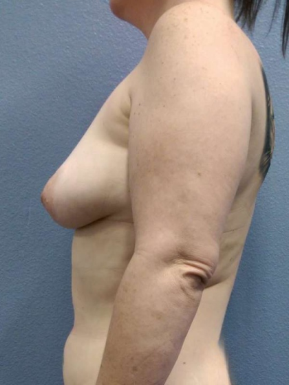 Breast Augmentation Before & After Patient #5729