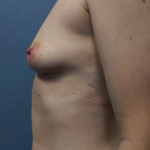 Breast Augmentation Before & After Patient #5706