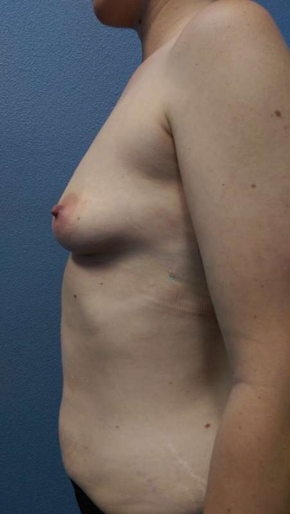 Breast Augmentation Before & After Patient #5706