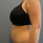 Liposuction Female Before & After Patient #8101