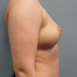 Breast Augmentation Before & After Patient #5445