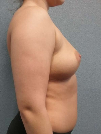 Breast Augmentation Before & After Patient #5445