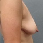 Breast Augmentation Before & After Patient #6749