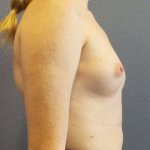 Breast Augmentation Before & After Patient #6993