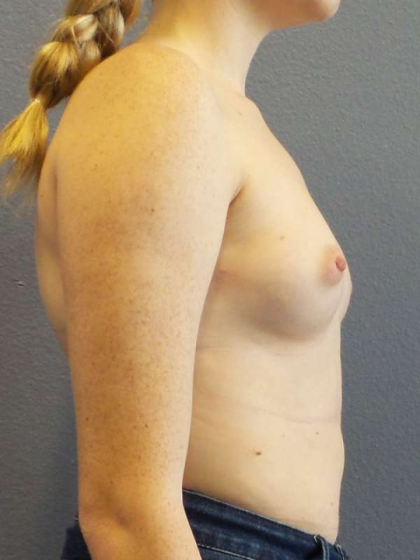 Breast Augmentation Before & After Patient #6993