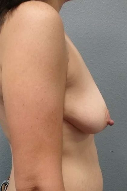 Breast Augmentation Before & After Patient #6749