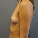Breast Augmentation Before & After Patient #6457