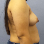 Breast Augmentation Before & After Patient #5114