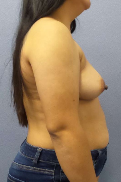 Breast Augmentation Before & After Patient #5114