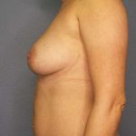 Breast Augmentation Before & After Patient #6348