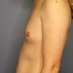 Breast Augmentation Before & After Patient #11573