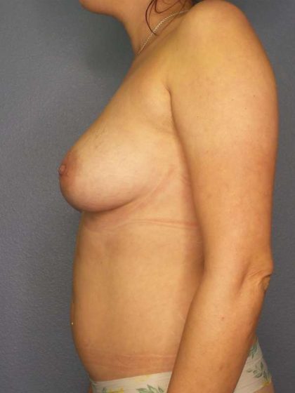 Breast Augmentation Before & After Patient #6348