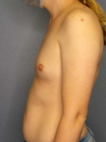 Breast Augmentation Before & After Patient #11573