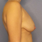 Breast Lift with Implant (Augmentation Mastopexy) Before & After Patient #3934