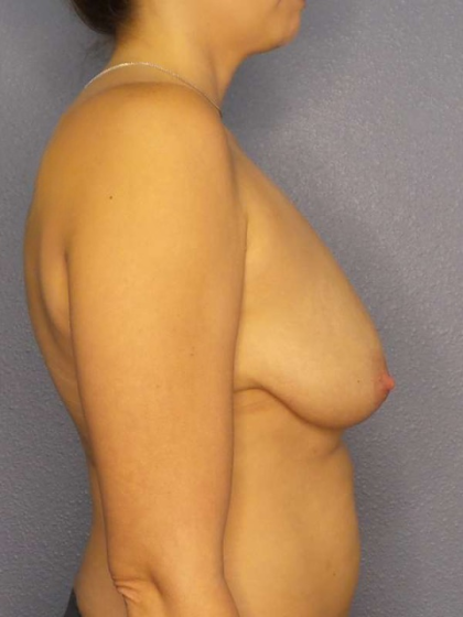 Breast Lift with Implant (Augmentation Mastopexy) Before & After Patient #3934