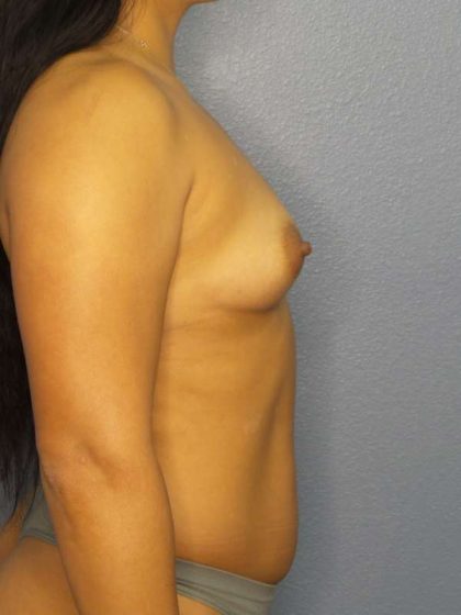 Breast Augmentation Before & After Patient #5661