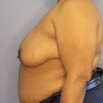 Mastopexy (Breast Lift) Before & After Patient #8402