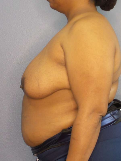 Mastopexy (Breast Lift) Before & After Patient #8402